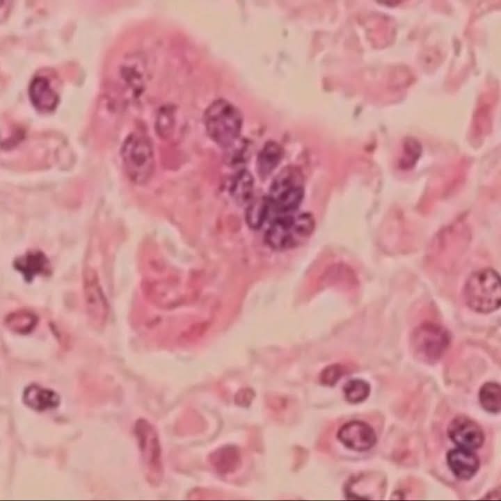 The recent measles exposure at the Ark Encounter isn’t an isolated incident — it…